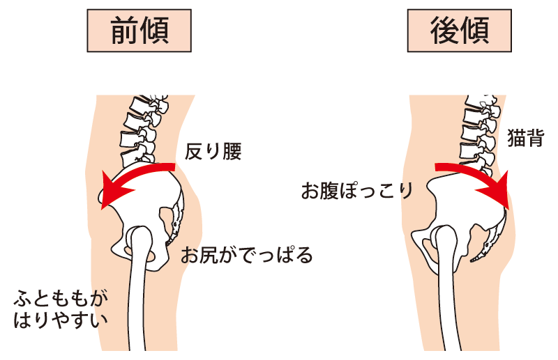 骨盤の前傾と後傾のイラスト